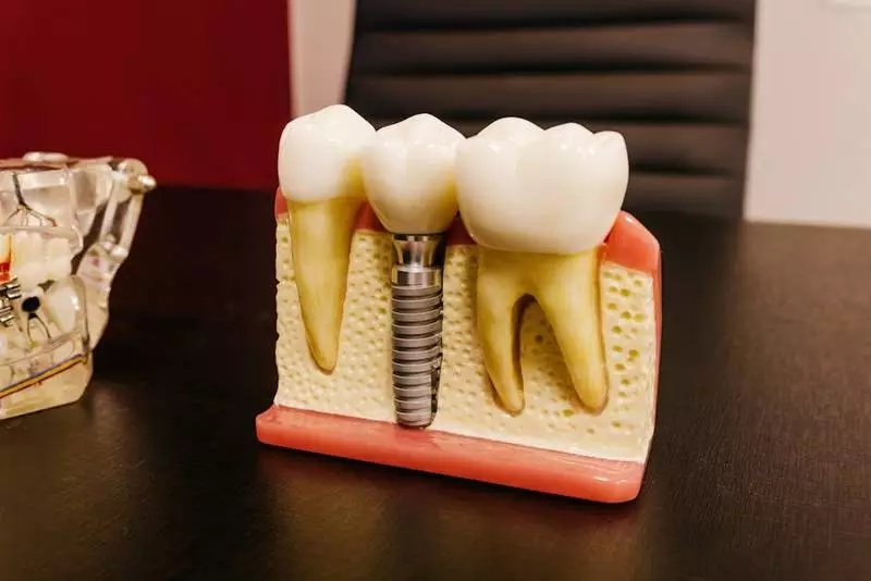 Czy implanty zębowe są bezpieczne?